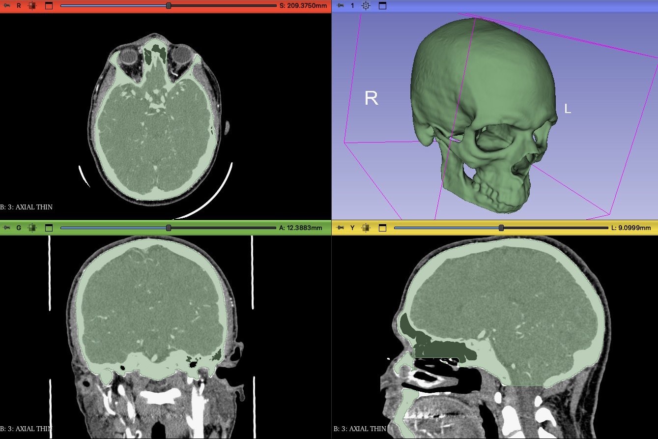 Segmented CT scan data showing skull structure prepared in 3D Slicer